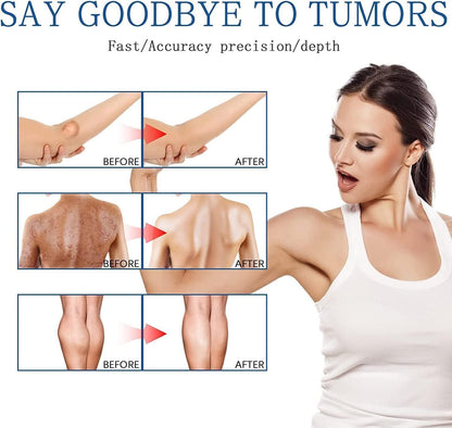 Lipoma Removal Spray (Original)