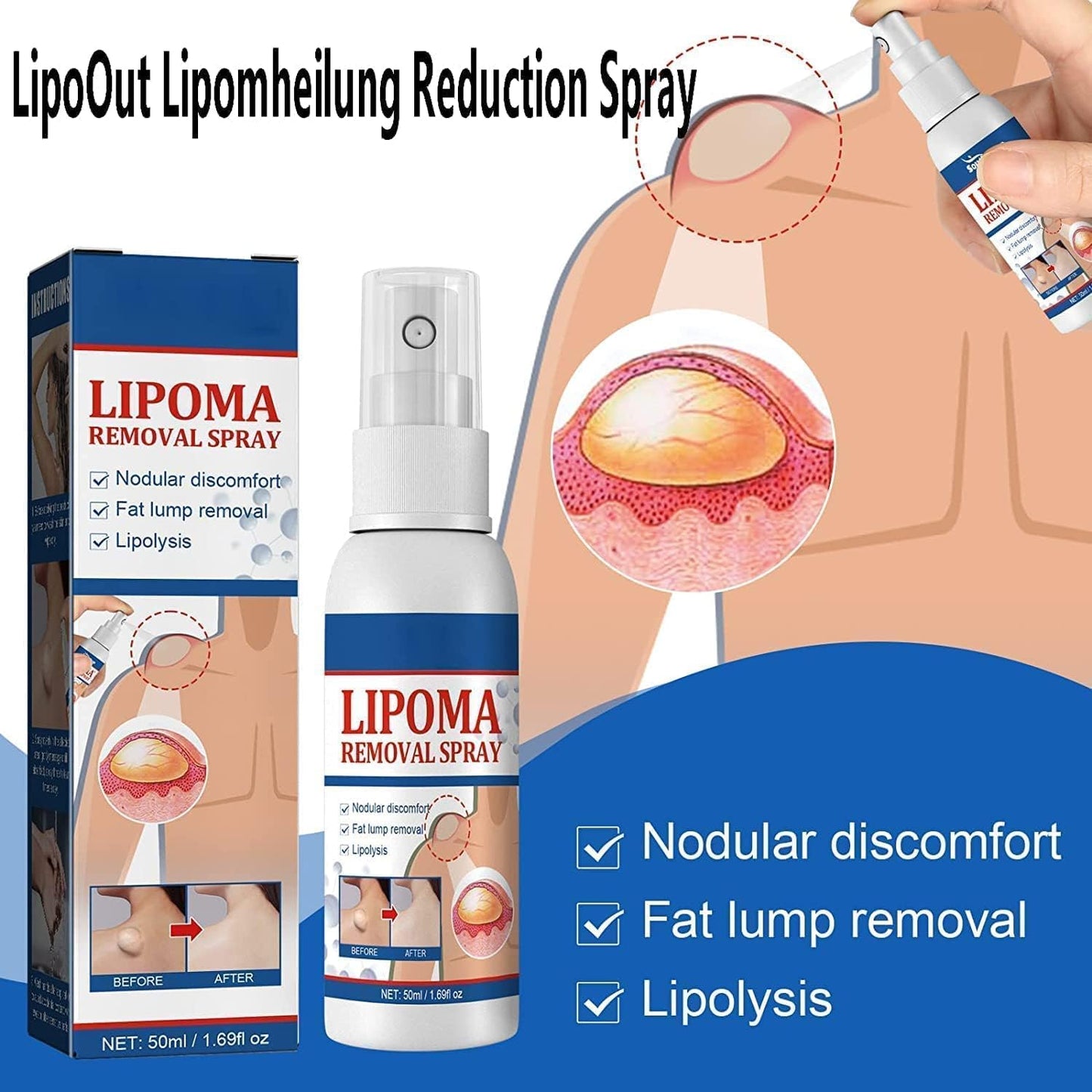 Lipoma Removal Spray (Original)